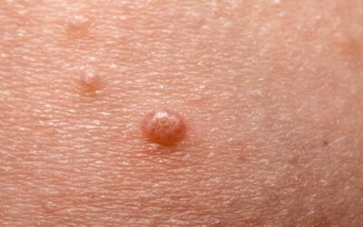 Treating Molluscum in Autism – One Mom’s Story